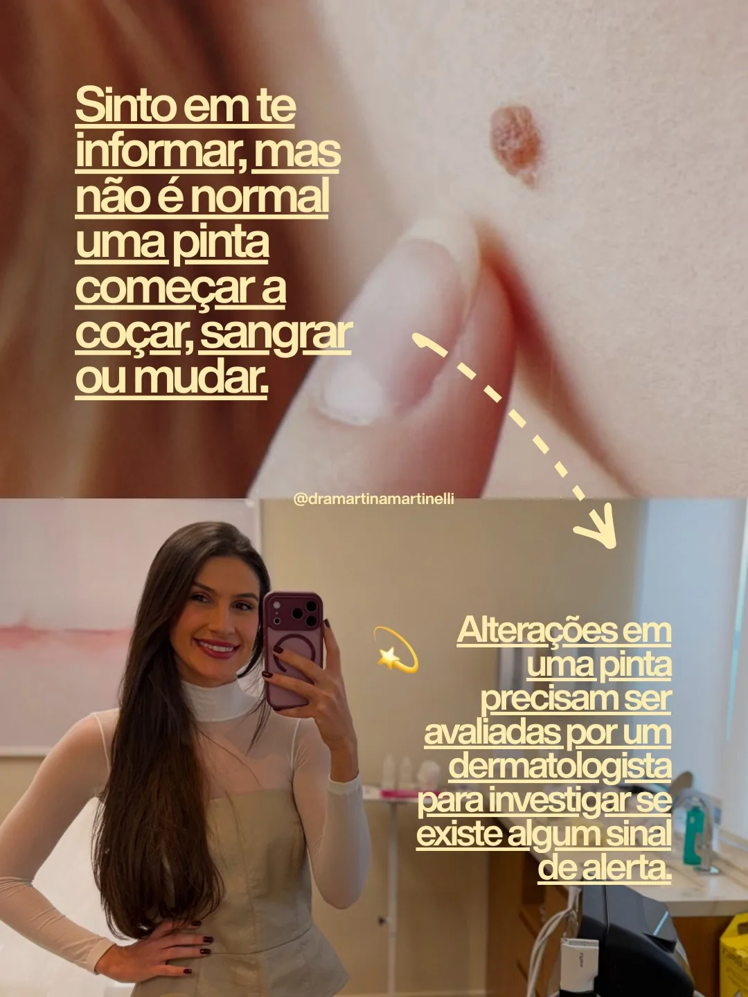 Close de uma pinta na pele — da série 'não é normal', conteúdo autoral da médica
